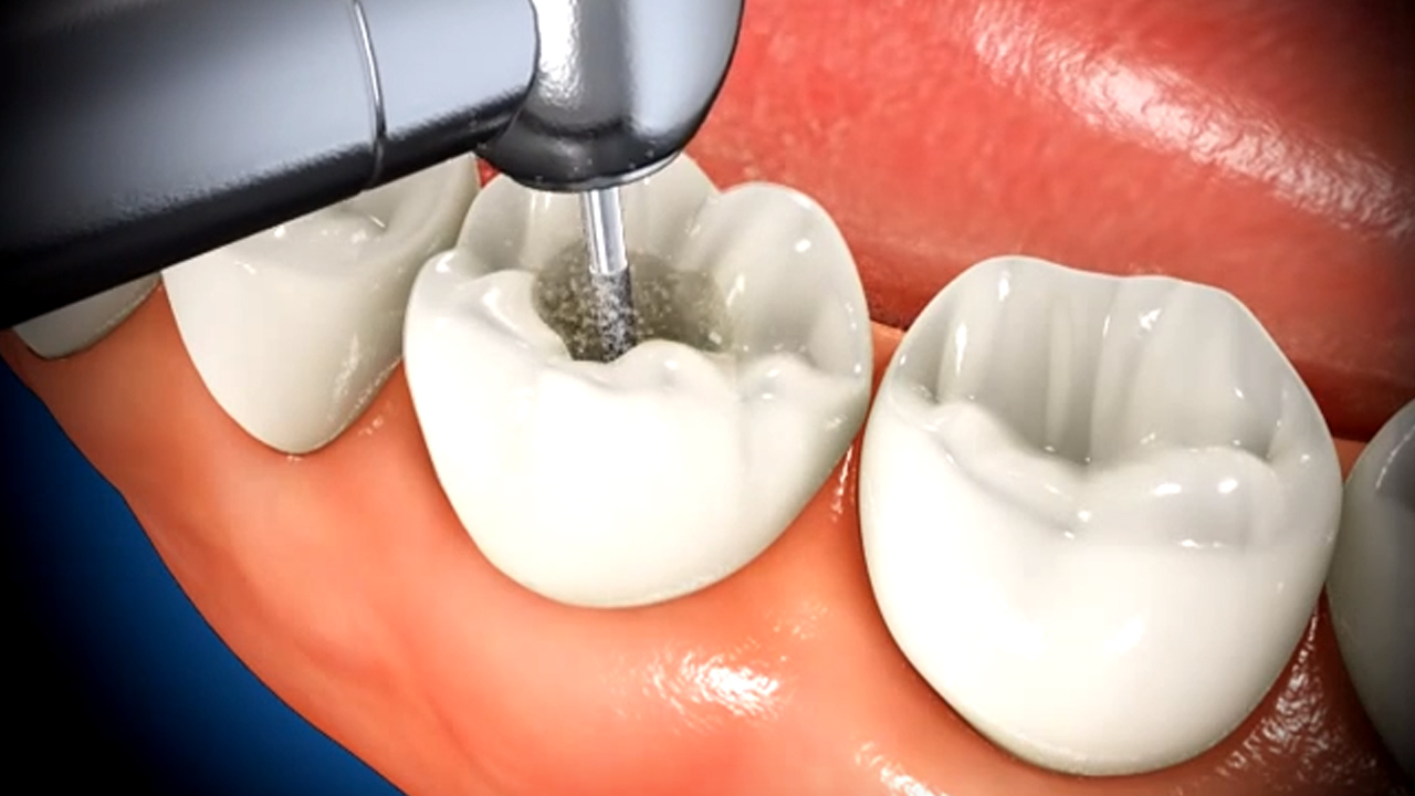 What To Expect When Getting A Root Canal Featured Image - Tippin Dental Group