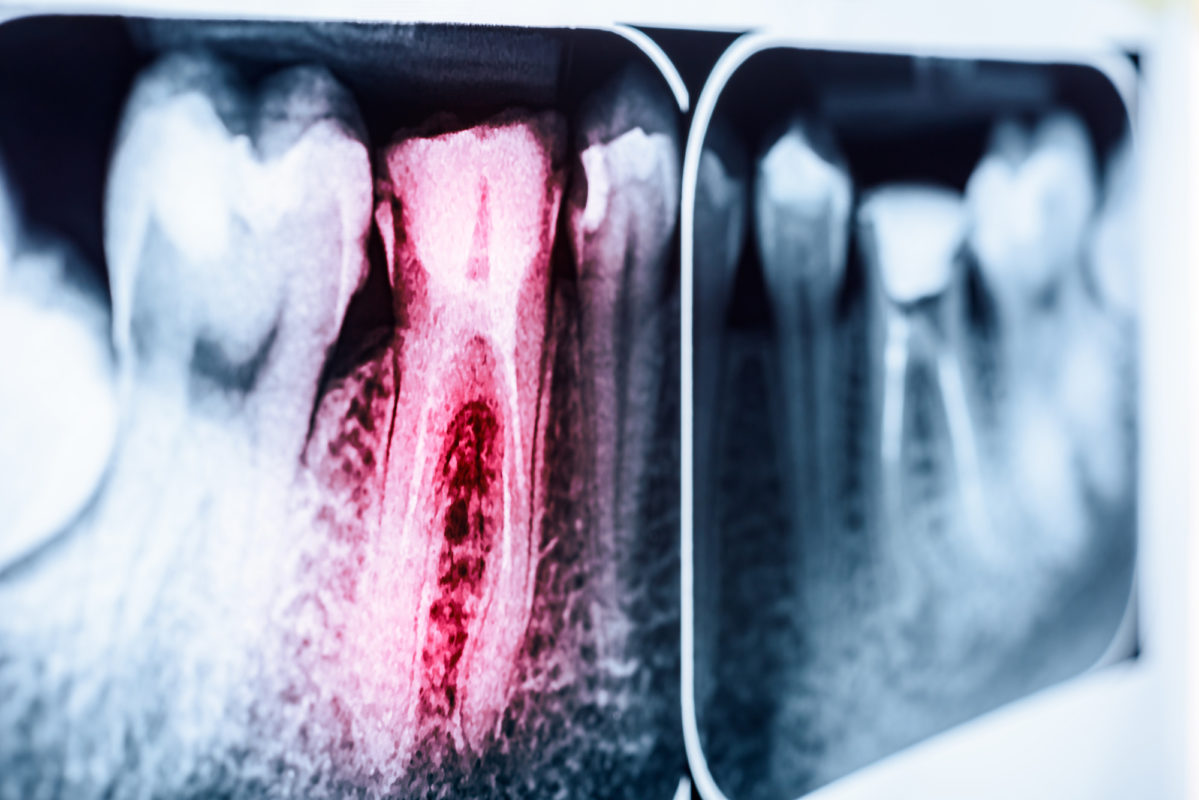 Answers To Common Root Canal Treatment Questions Featured Image - Tippin Dental Group