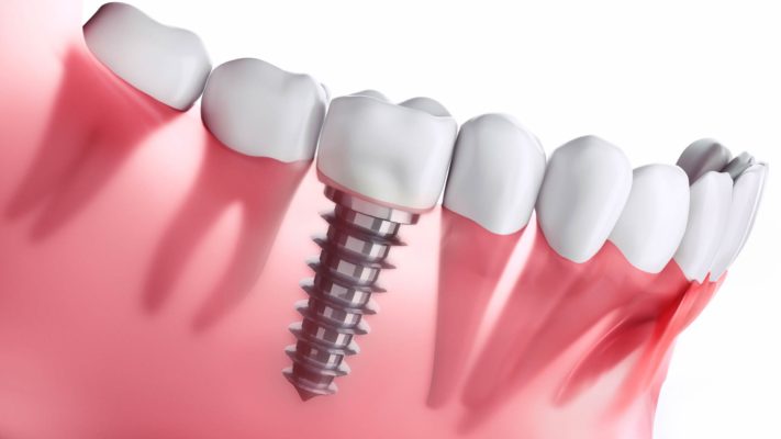 How Do Dental Implants Work Featured Image - Tippin Dental Group