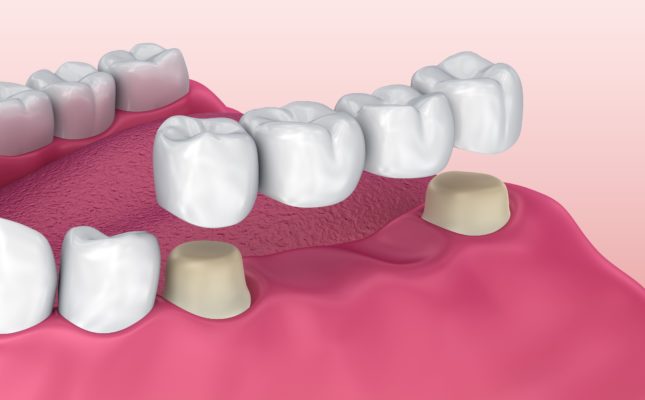 Missing a Tooth? A Dental Bridge May Be the Answer Featured Image - Tippin Dental Group