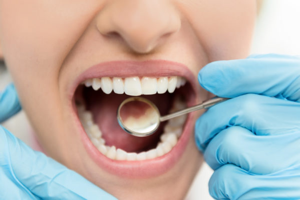A Dental Restoration You Can Love Featured Image - Tippin Dental Group