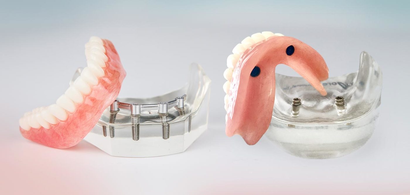 5 Things You Need To Know About Dentures Featured Image - Tippin Dental Group