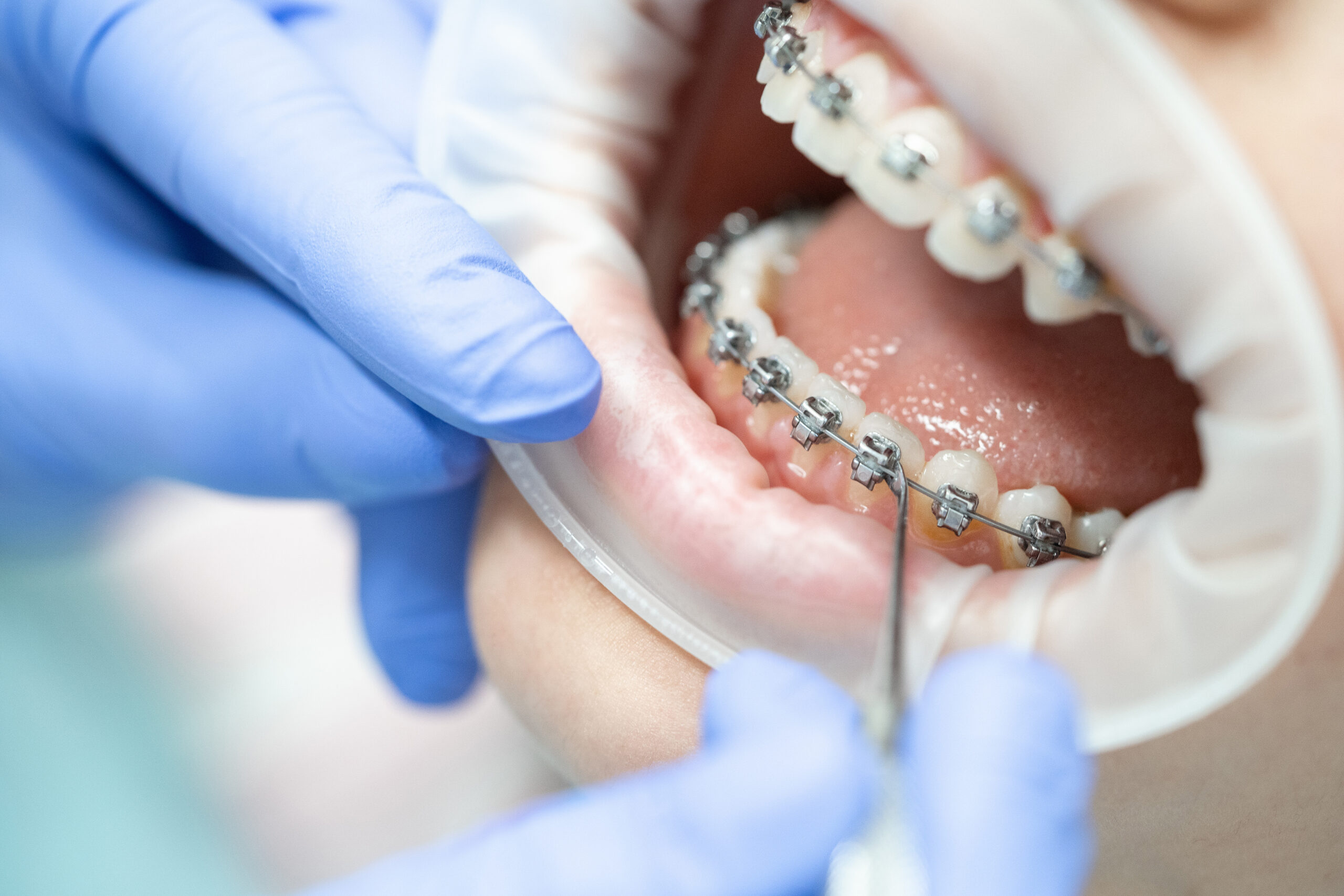 Close-up of teeth with braces. Dentistry and the procedure for a